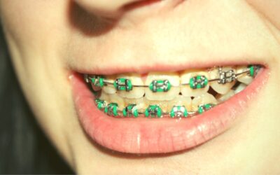 Ortodoncia para novatos: 9 consejos