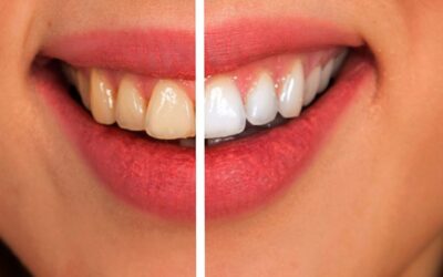 Cuidado con los remedios caseros de blanqueamiento dental