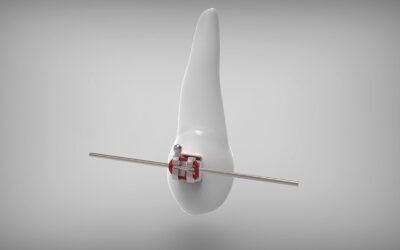 ¿Cuánto dura el tratamiento de ortodoncia?