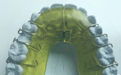 ¿Qué sabes de los retenedores?