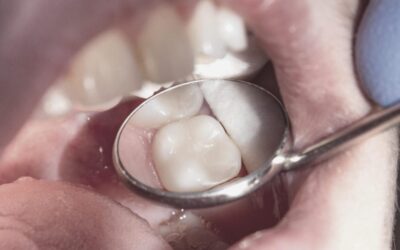 Todo sobre la ortodoncia lingual