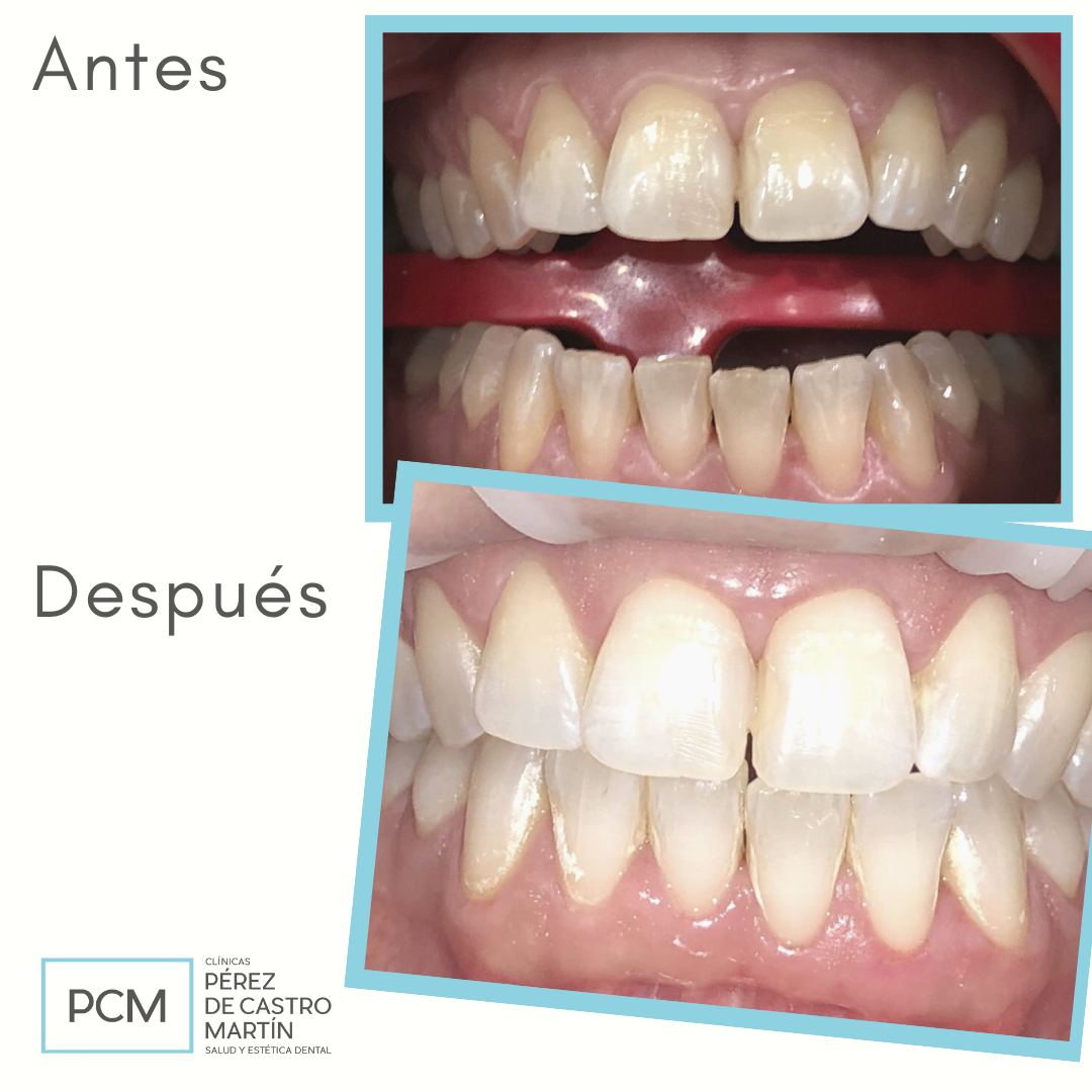 Resultado de blanqueamiento dental en Córdoba - Clínica Dental PCM