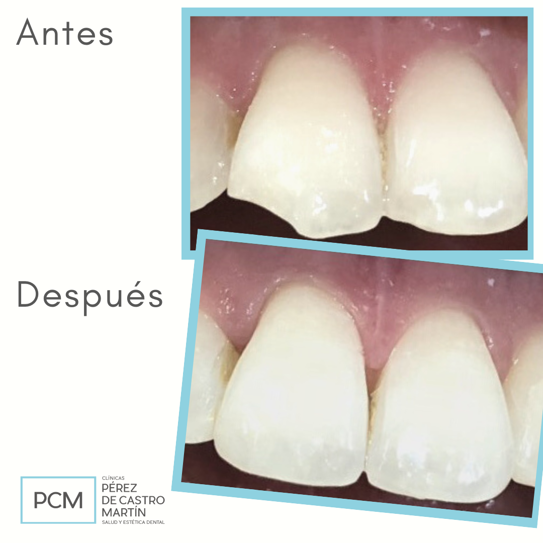 Fractura de diente - PCM Clínica Dental en Córdoba