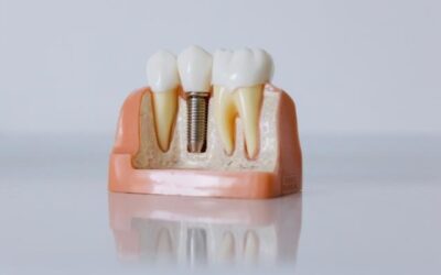 ¿Qué es un implante dental?