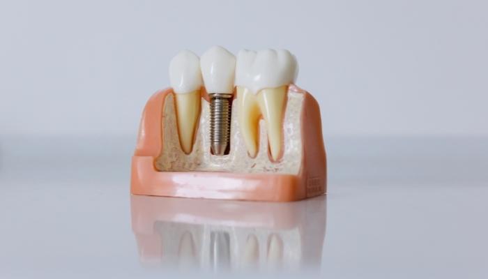 ¿Qué es un implante dental