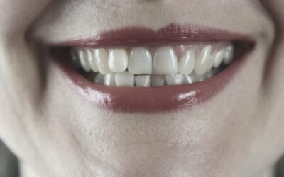 Haz que tu blanqueamiento dental dure más tiempo