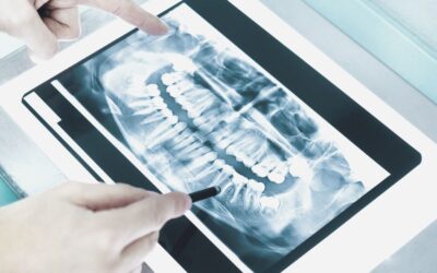 Qué hacer si se te ha caído un empaste