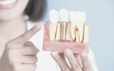 Diferencia entre implantes y puentes dentales