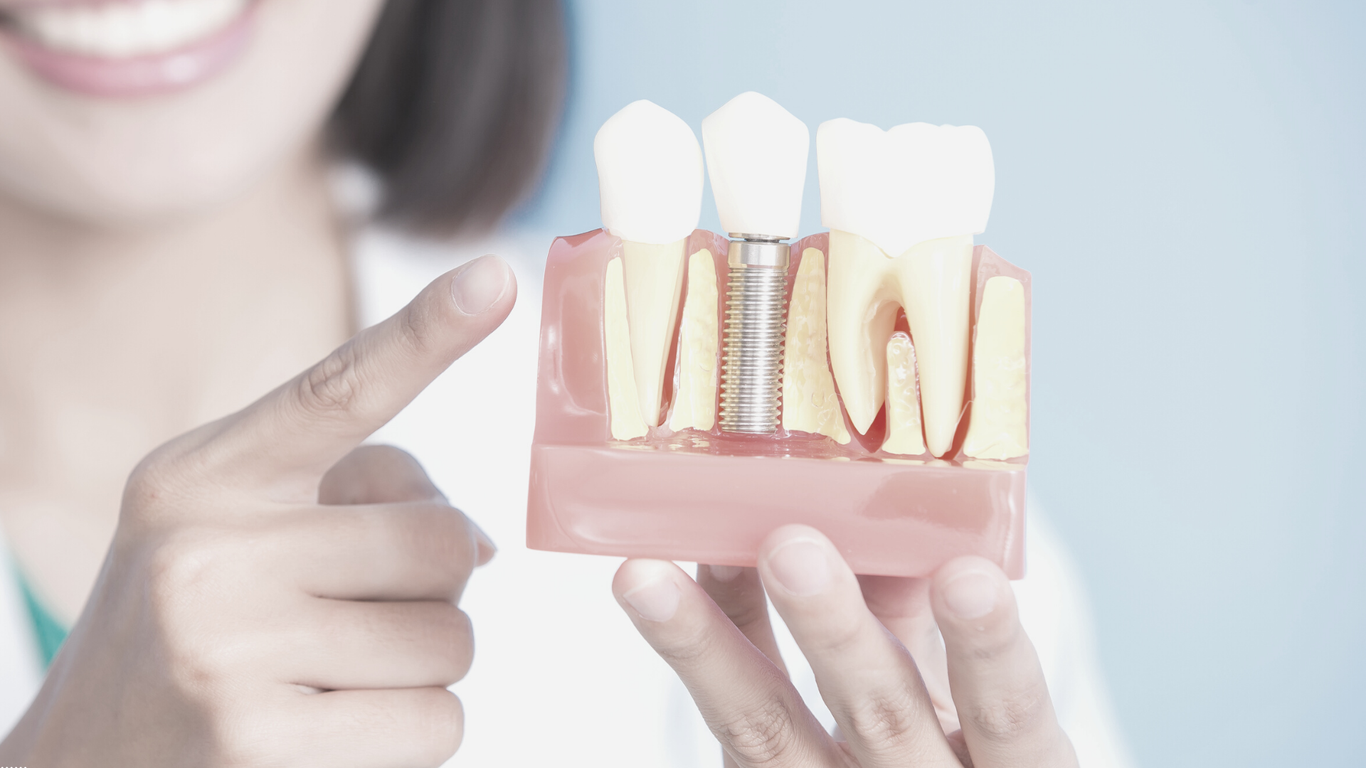 Diferencia entre implantes y puentes dentales