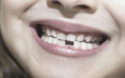 Qué es y cómo tratar la agenesia dental