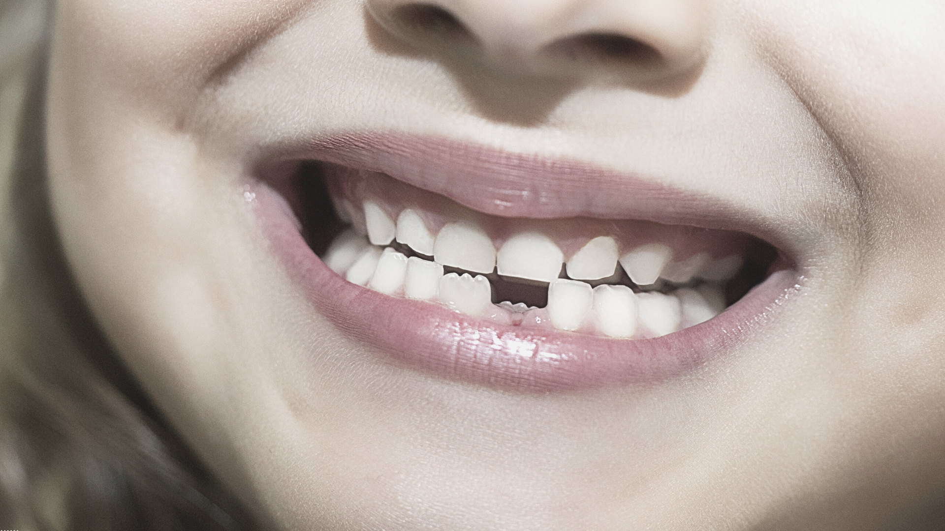 Qué es y cómo tratar la agenesia dental