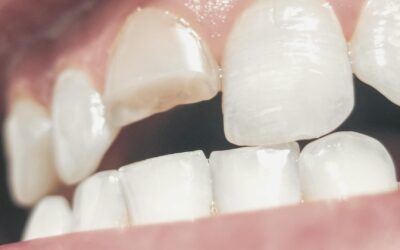 Fractura dental: qué es, tipos y cómo tratarla