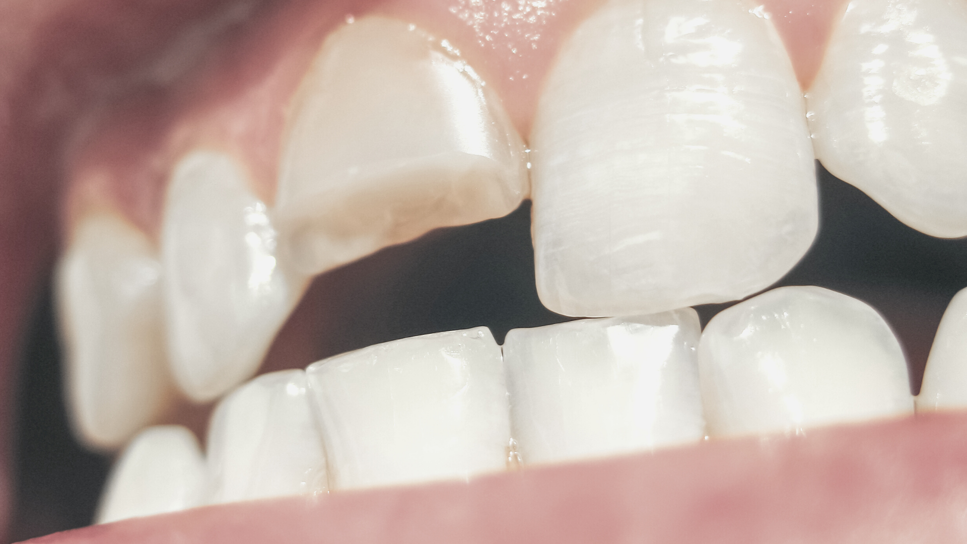 Fractura dental: qué es, tipos y cómo tratarla