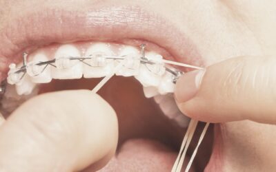 Qué son y para qué sirven las gomas de los brackets