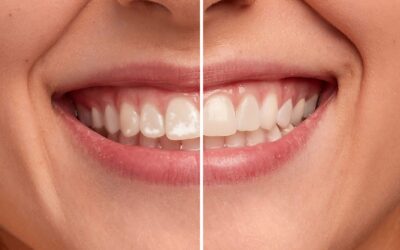 Manchas blancas en los dientes: qué son, por qué aparecen y cómo eliminarlas