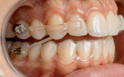 Distalizador de Carriere: qué es, cómo funciona y cómo cuidarlo paso a paso