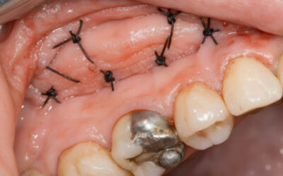 Recomendaciones después de una cirugía de elevación de seno maxilar: guía práctica para una recuperación segura