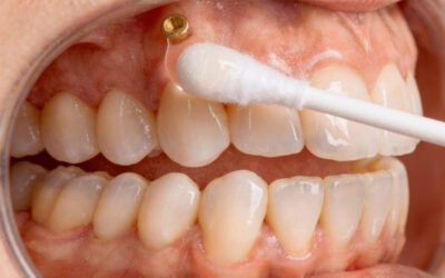 Microtornillos en ortodoncias: qué son y cómo cuidarlos para que tu tratamiento avance más rápido