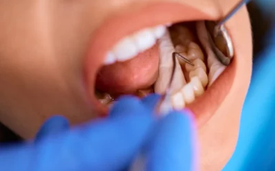 Caries y enfermedad periodontal: por qué no son solo problemas de dientes
