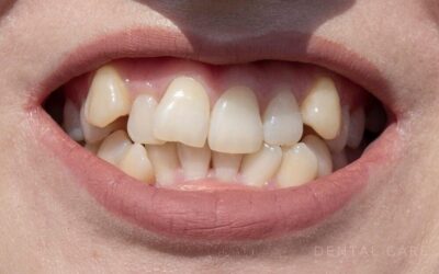 Apiñamiento dental: qué es y cómo puede ayudarte la ortodoncia