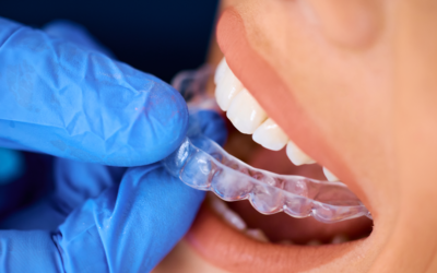 Brackets estéticos o transparentes: opciones para alinear los dientes sin que se note tanto