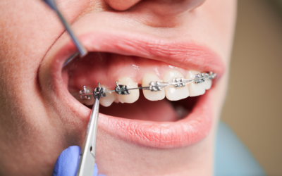 Diastemas o dientes separados: causas y cómo corregirlos