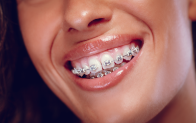 Dientes feos o sonrisa desalineada: qué soluciones existen