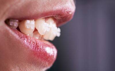 Dientes salidos hacia fuera: causas y soluciones con ortodoncia